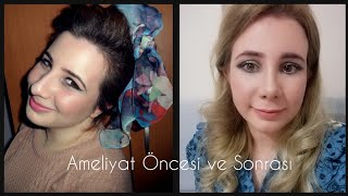 2. Kez Burun Ameliyatı Oldum (1 Aylık Süreç) Dr. Hüseyin Altun