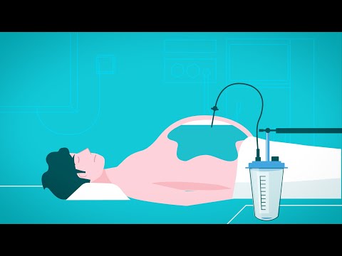 Vidéo: Comment traiter le ventre d'eau ?