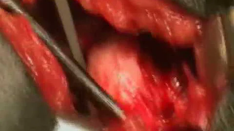Quanto custa uma cirurgia de displasia coxo femural?
