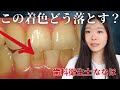 着色を落とす方法と着色防止のコツを歯科衛生士が解説します。