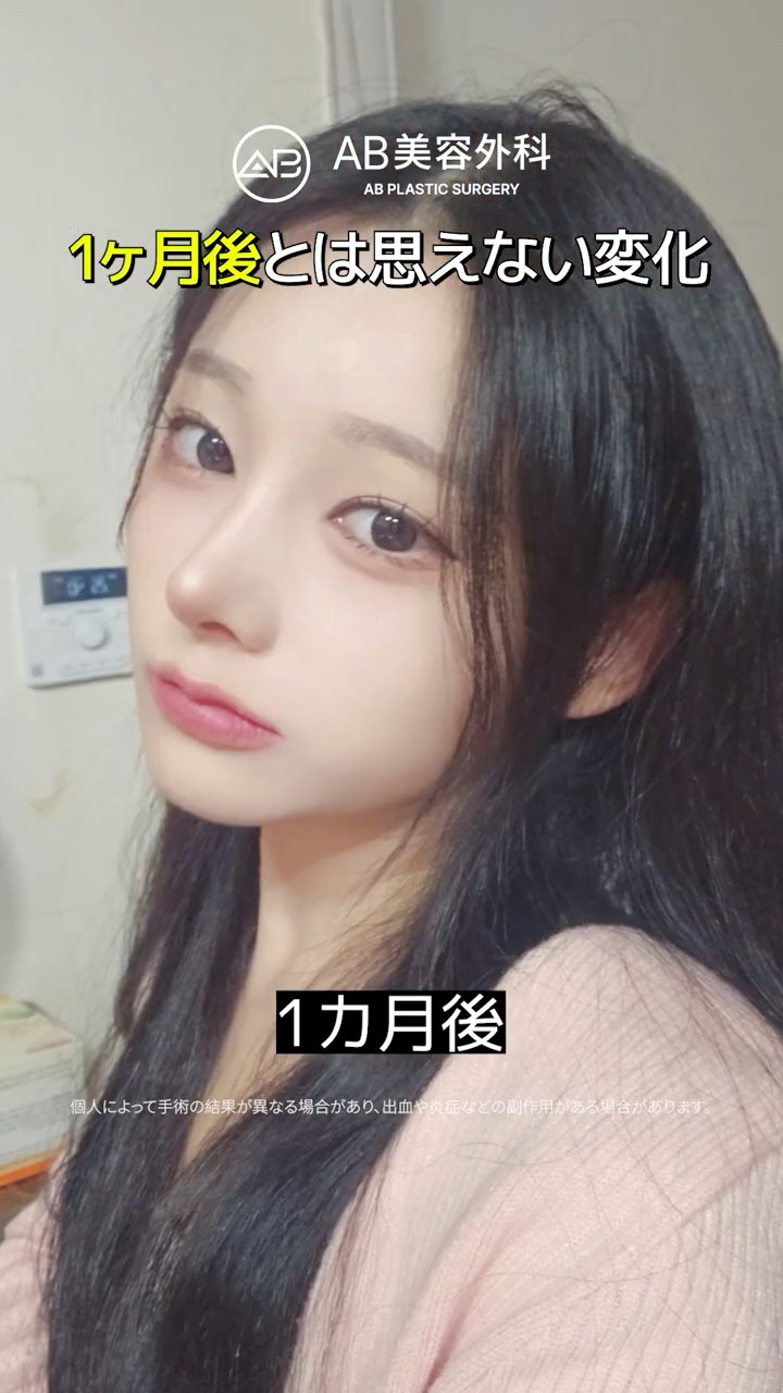 韓国 目整形＋鼻整形で自信が持てるようになった！#Shorts
