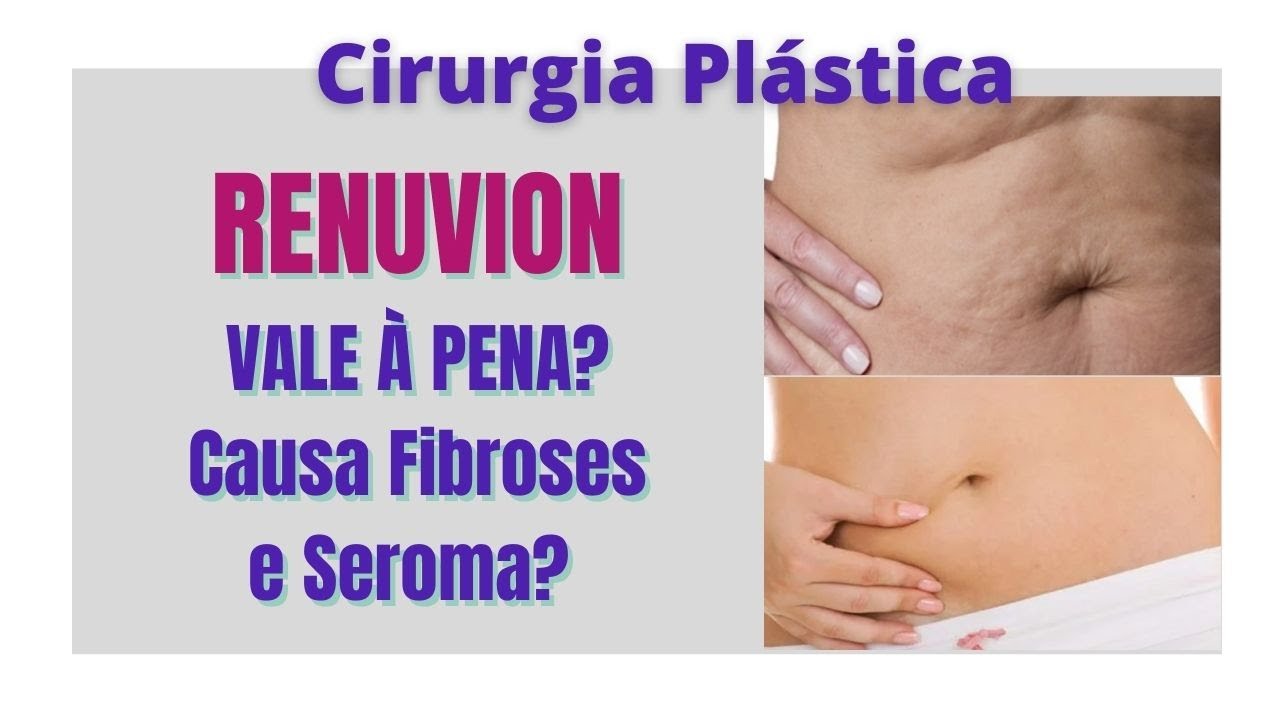 Renuvion vale a pena? Como ter bons resultados, lipoaspiração e ...