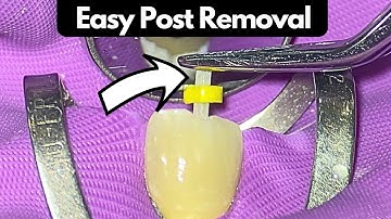 Efficient Fibre Post Removal Technique: A Step-by-Step Guide
