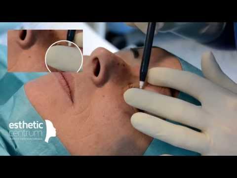 Operácia horných viečok (blefaroplastika) – eveclinic