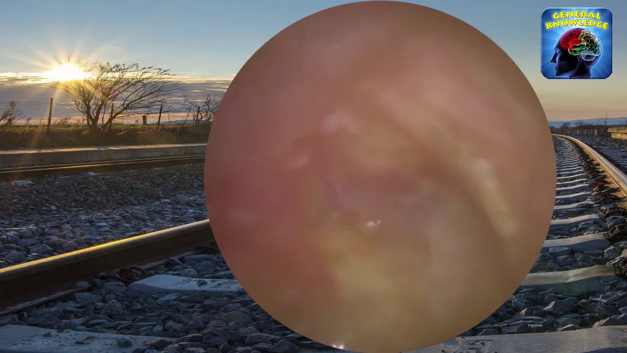 Endoscopic Suction in Inflamed and Closed Ear Canal Entrance [64] YouTube