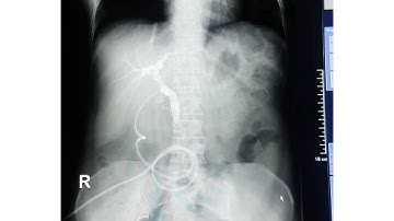 T Tube Cholangiography