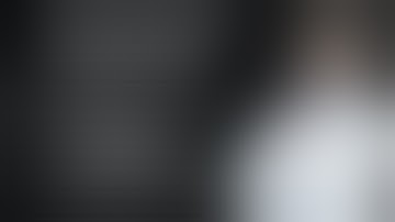 Laparoscopic excision of GIST of the stomach by Endo-stapler