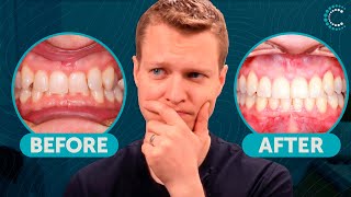TEETH WERE DESTROYING EACH OTHER! Impossible Transformation Solved with Invisalign Ep2
