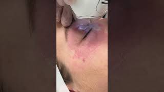 Tixel Treatment