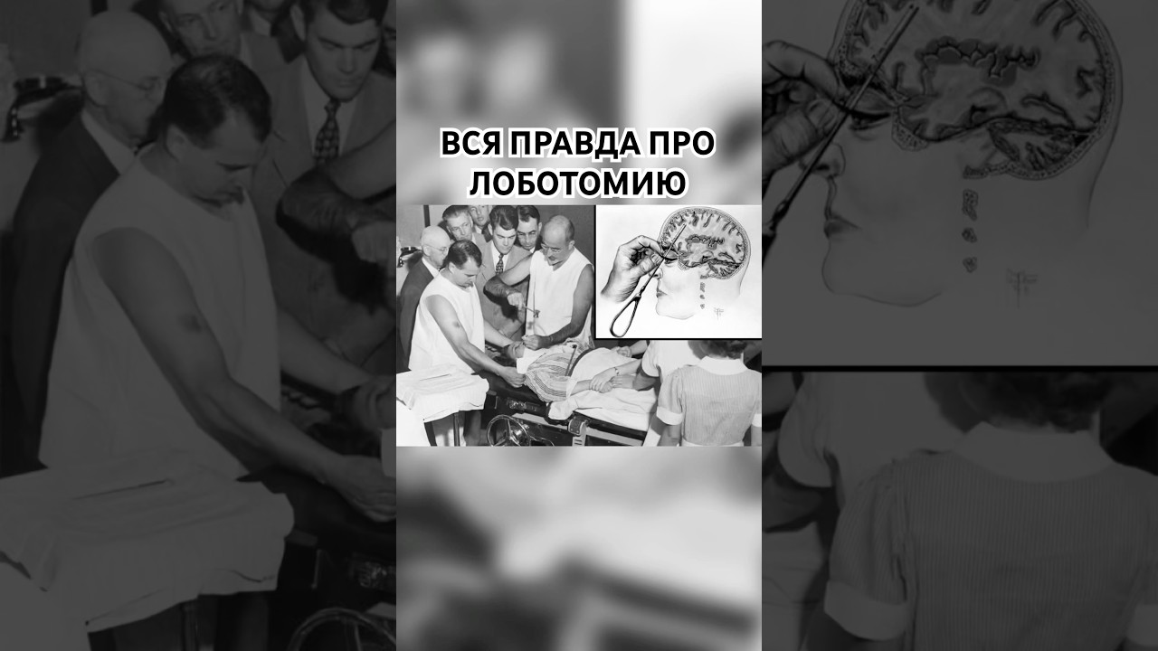 Вся правда про лоботомию ! добейте 100 подписчиков 🫶
