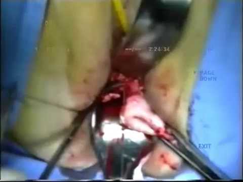 Video: Salpingo-Oophorectomy: Procedure, Gendannelse, Risici Og Mere