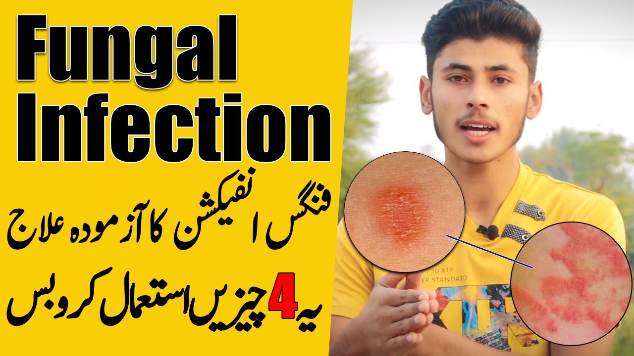 Fungal Infection On Skin Treatment In Pakistan Fungal Infection