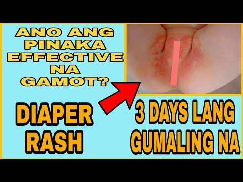 Video: Ano ang gagawin sa diaper rash sa isang bata sa bahay