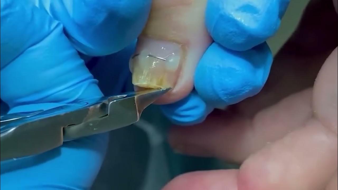 Installing titanium wire to correct the ingrown toenail! YouTube