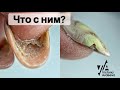 Гипонихий. Ремонт ногтей. Аппаратный маникюр. Виктория Авдеева