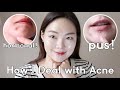 how I deal with acne +real demonstration (realistic)