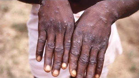 VERIFY: Detecting monkeypox rashes