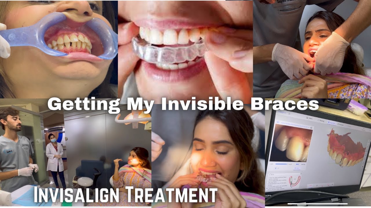 GETTING MY INVISIBLE BRACES FINALLY 😬🦷 Cost and Procedure of