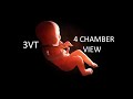 3vt and 4 chamber view   how to find in obstetric ultrasound