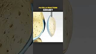 Patella Fracture Surgery (3D Animation)#3danimation #medicaleducation #healthcare #fyp