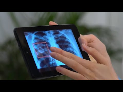 Video: COPD-Diagnose: Spirometrie, Röntgen Und 6 Weitere COPD-Tests