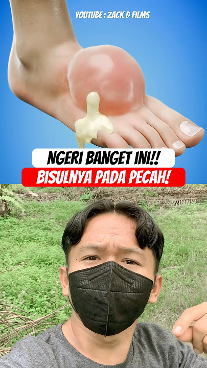 Ngeri bisulnya pada pecah #facts #foot #lifehacks #relax #satisfying #elchombo #reaction