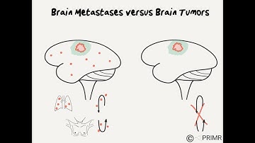 Brain Metastases versus Brain Tumors