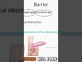 Contraception#mbbs #usmle #medicalstudent #foryou #fyp #everyone