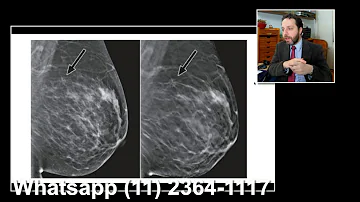 Como aparece câncer na mamografia?