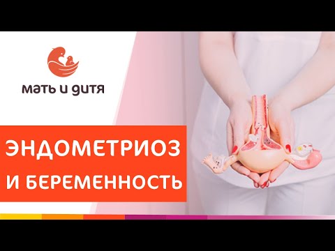 🤰 Возможна ли беременность при эндометриозе? Эндометриоз и беременность. MD GROUP. 18+