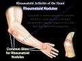 Rheumatoid Arthritis of the hand - Everything You Need To Know - Dr. Nabil Ebraheim