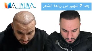 لقد زرعت شعري و تخلصت من مشكلة الصلع