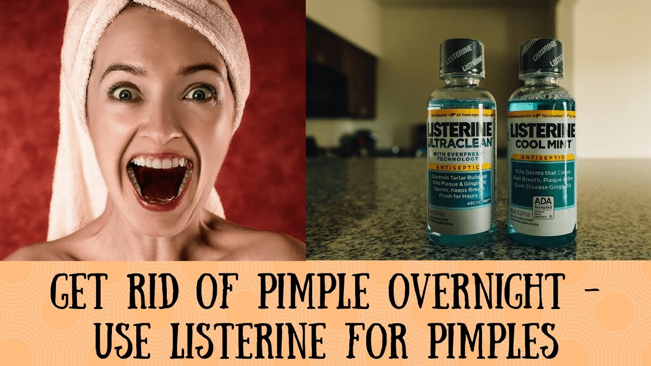 Get rid of pimple overnight - Use Listerine for Pimples | About Ladies - YouTube