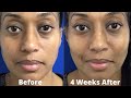 Dermal Filler Under Eyes and Cheek Restoration ~ Tear Trough