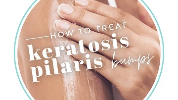 How to Treat Keratosis Pilaris Bumps