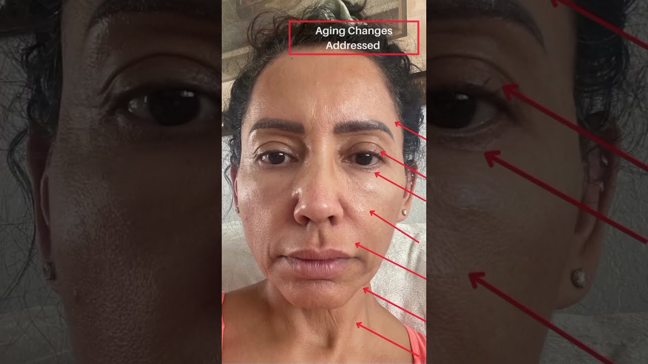 INCREDIBLE Facelift Transformation She Looks 15 YEARS YOUNGER