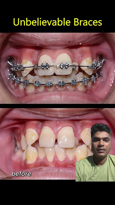 Unbelievable orthodontist braces tritment #dentist #yt #dentalclinic #ytshorts #dentalcare #ytshorts