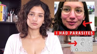 I HAD PARASITES | Itchy Skin, Acne, Bad Digestion | How I treated it (not natural)