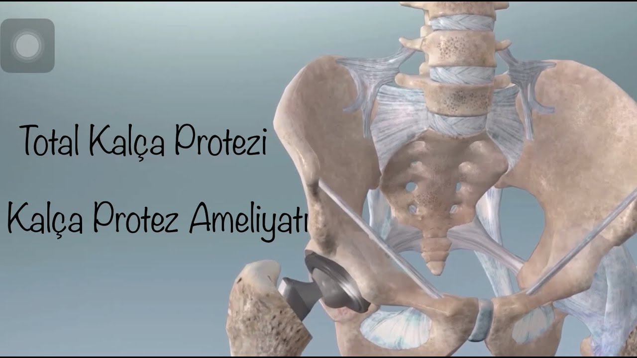 Kalça protezi nedir ve Ameliyatı nasıl yapılır