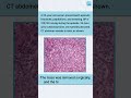 Pheochromocytoma CT Case | NEET PG Spotter