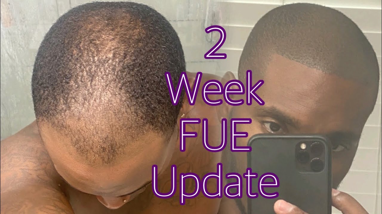 Black Male FUE Week 2