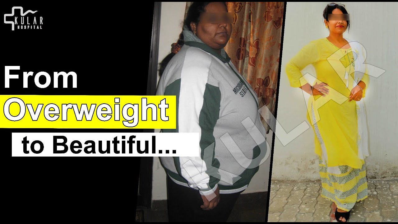 10 years after Bariatric Surgery| Best Weight Loss Results at Kular Bariatrics| Dr. K.S. Kular