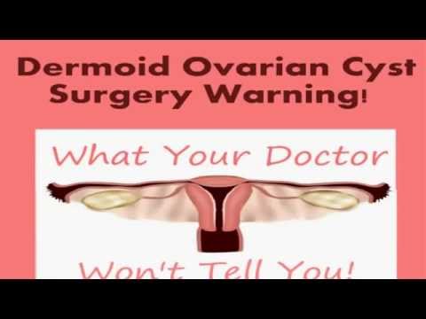 beware-from-dermoid-ovarian-cyst-►best-ways-to-cure-dermoid-ovarian-cyst