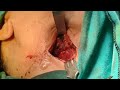 Submandibular sialoadenectomy by dr mohamed elshamaa