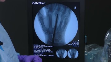 Antegrade Intramedullary Screw Fixation of a Metacarpal Shaft Fracture