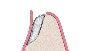 Greffe Osseuse Pose Implant