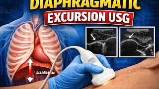 How to measure Diaphragm excursion #criticalcaremedicine #aiimsdelhi #aiimsraibareli #pocus