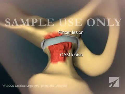 Импиджмент-синдром вертлужной впадины