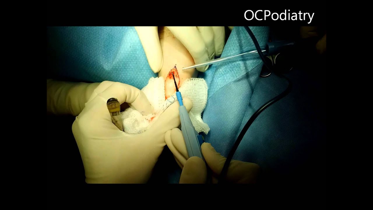 Large Wart on Foot surgical excision YouTube