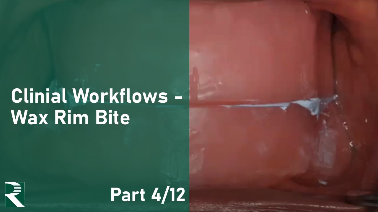 Transition Toward Digital Dentures: Clinical Workflows - Wax Rim Bite ...